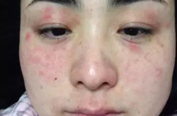 脸过敏的症状,识别与应对策略